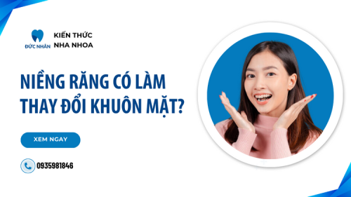 Niềng răng có làm thay đổi khuôn mặt và sự thật?